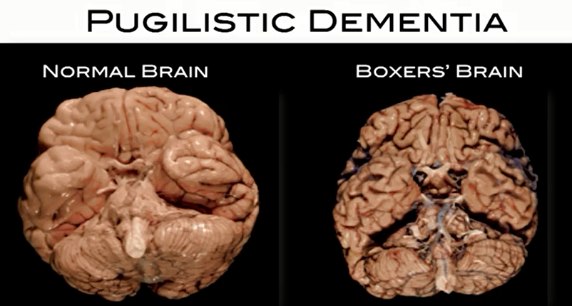 foto dementia pugilistica